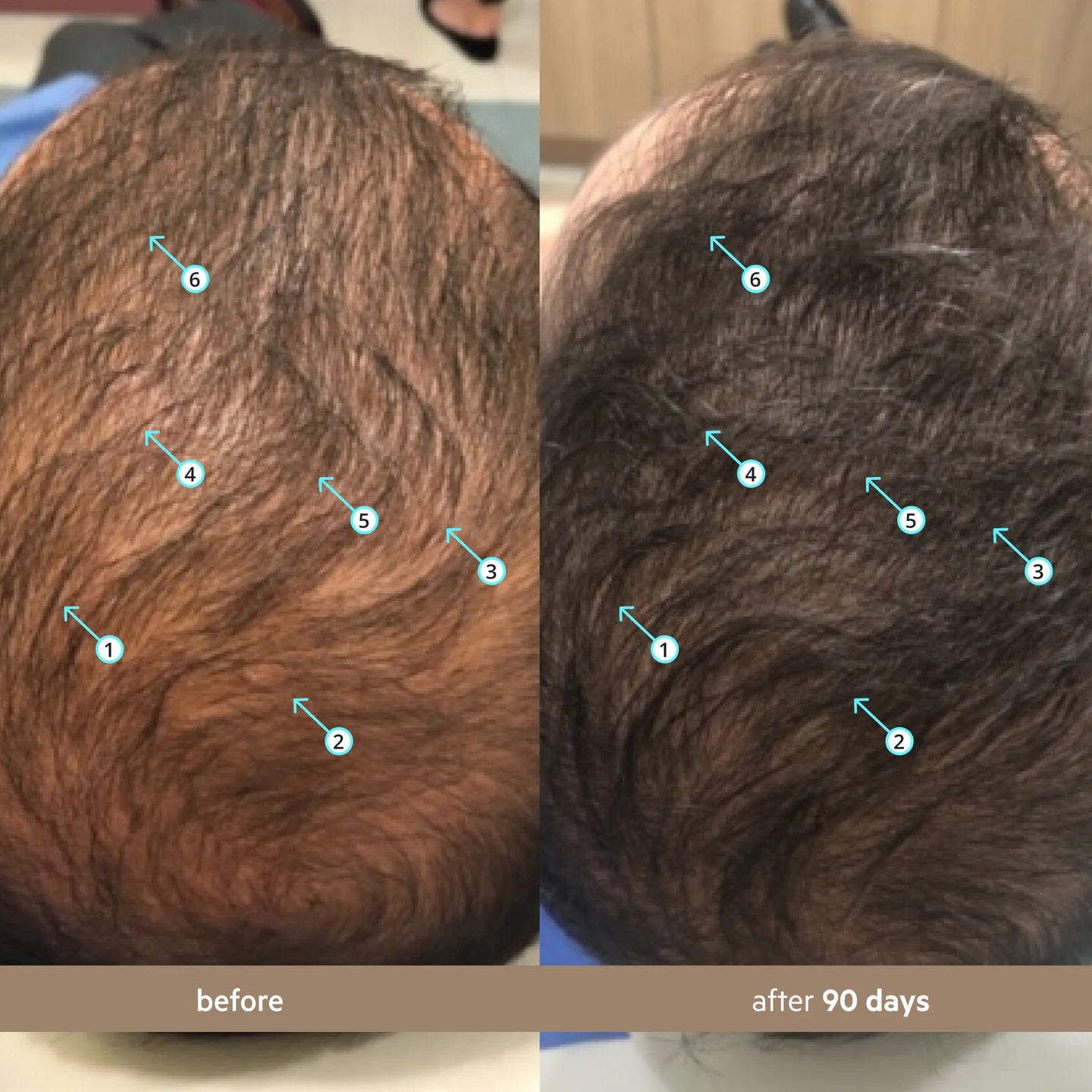 Revita Hair Density Serum – Advanced Growth Formula