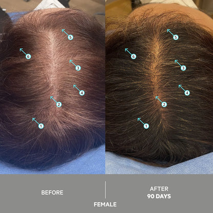Revita Extra Strength Hair Density Serum – Intensive Regrowth Formula