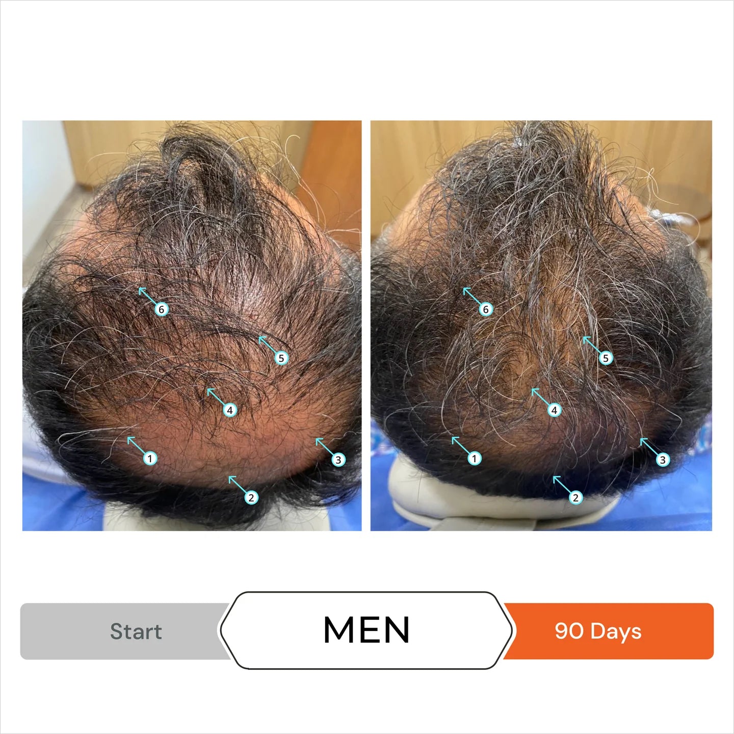 Revita Men’s Hair Regrowth Stimulation Kit