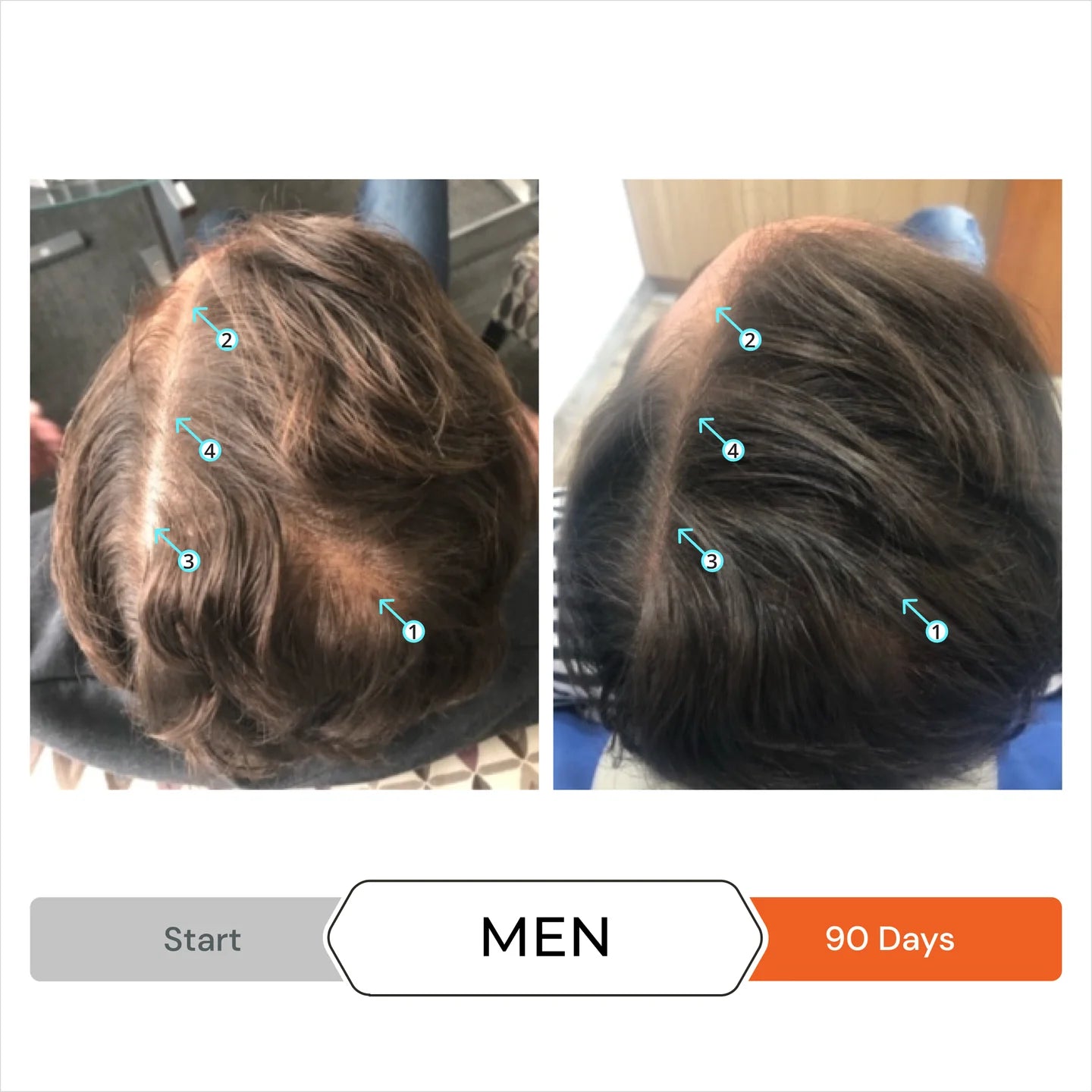 Revita Men’s Hair Regrowth Stimulation Kit