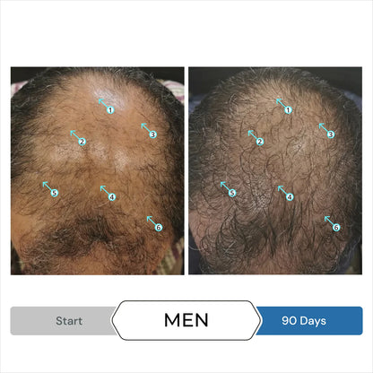 Revita Men’s Hair Regrowth Stimulation Kit